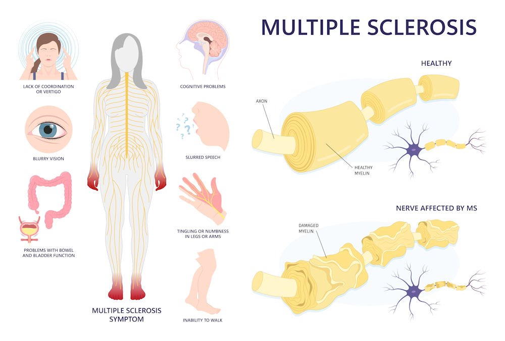 multiple sclerosis