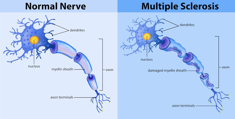 normal nerve vs multiple sclerosis