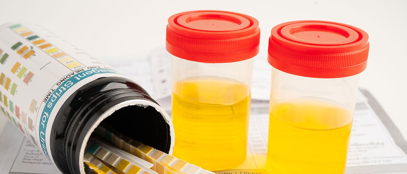 Urine tests typically detect lisdexamfetamine as amphetamine